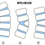 [Topic]脊柱側弯症